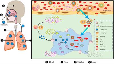 The role of IL-6 in coronavirus, especially in COVID-19